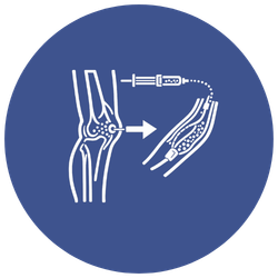 Genicular Artery Embolisation (GAE)